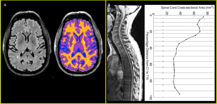 Figure 1. A. Machine learning based brain segmentation showing CSF (blue), gray matter (purple), white matter (yellow), and lesions (red) in an HIV-infected individual (PI: Avi Nath, NINDS). B. Spinal cord cross-sectional area along the length of the cord as an imaging marker for cord atrophy from an individual (PI: Steve Jacobson, NINDS)
