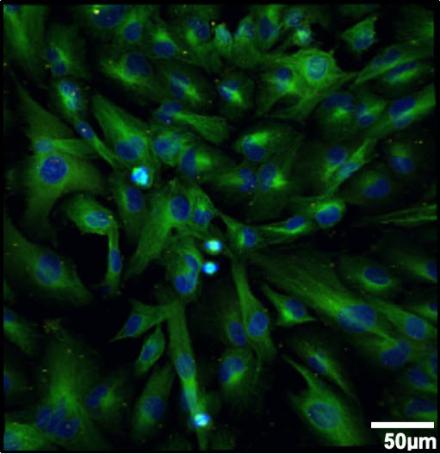 Figure 1. Fluorescence microscopy of GBM cell line stained with DAPI (blue); ARL13-B (red) and acetylated--tubulin. Short, morphologically abnormal primary cilia are associated with most nuclei. Magnification: 40X