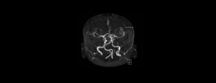 STAT1 mutations give deeper insight into cerebral aneurysms 