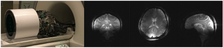 pTx Brain MRI