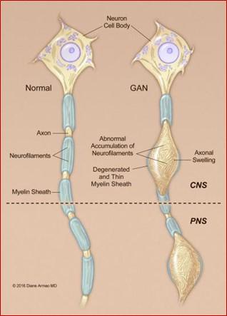 Giant axonal neuropathy (GAN) is a rare neurodegenerative disorder that results in abnormally large and dysfunctional axons, affecting movement and sensation. An investigational gene therapy could help slow the progression of GAN. Credit: Diane Armao, M.D., UNC School of Medicine