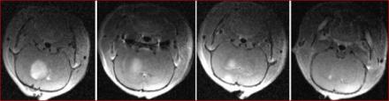 Brain MRIs reflect additive ibrutinib effect of ibrutinib compared to vehicle (left panel), doxil alone (left middle panel), ibrutinib alone (right middle panel), or ibrutinib + doxil (right panel).