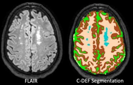 Representative fluid-attenuated inversion recovery (FLAIR) images (left) with corresponding segmentation output of Classification using Derivative-based Features (C-DEF; right) from one study participant showing white matter hyperintensities and sulcal atrophy. Segmented output shows gray matter (brown), white matter (beige), cerebrospinal fluid (green), and white matter hyperintensities (teal).