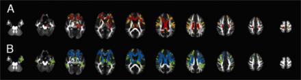 Diffusion tensor imaging of a group of C9orf72 mutation carriers shows a frontal predominance of white matter disruption, with spread of regions with reduced fractional anisotropy (upper panel) from the initial scan (red) and a second scan 6 months later. White matter regions with increased mean diffusivity (lower panel) at the initial scan (blue) extend further posteriorly and into the temporal lobe 6 months later (green).