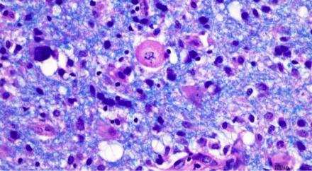 Creutzfeldt Astrocyte in Multiple Sclerosis