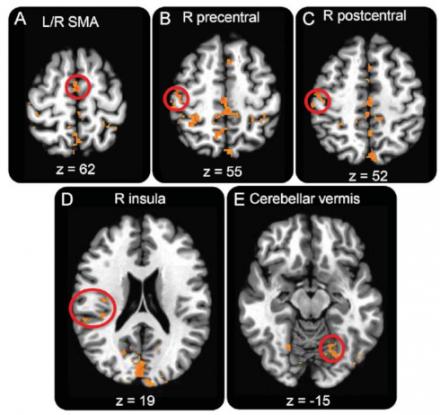 Maps of resting state fMRI demonstrate group differences in rTPJ resting-state functional connectivity (FC) between patients with FMD and healthy controls.