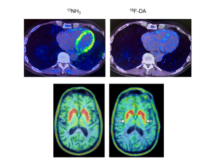 Heart and brain PET scans from a study participant who developed Parkinson’s disease support a “body first” progression. The top pair of PET scans show low 18F-dopamine-derived radioactivity in the heart (right) and a normal 13N-ammonia PET scan (left), which preceded a loss of dopamine-producing neurons and symptom onset. Goldstein lab, NINDS.