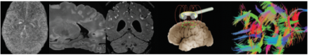 FROM LEFT TO RIGHT: Intracranial veins at 7T MRI; multiple sclerosis — postmortem 7T MRI; Susac Syndrome — subarachnoid space contrast enhancement; transcranial magnetic stimulation (TMS); diffusion tensor imaging (DTI).