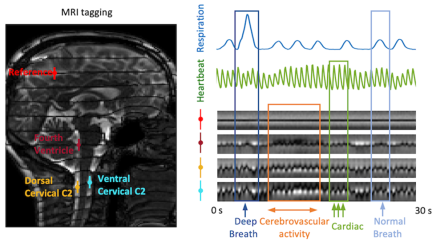 MRI tagging (dark lines in left image) allows quantifying CSF flow at multiple (4) locations. CSF velocity is quantified at four locations by vertical tag movement away from center (right panel). Sustained upward tag shifts following vascular response to deep inspiration indicate sustained CSF flow surge.