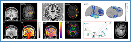 FROM LEFT TO RIGHT: (Left) Multimodality imaging acquired in patients with drug resistant epilepsy.  (Right) Intracranial electrode localizations are shown for a patient with temporal lobe epilepsy.  The superimposed color scheme indicates electrodes with maximal out-strength, ie. most frequently leading interictal epileptiform activity occurring in other electrodes, as demonstrated in the bottom row (from Diamond et al., Clin Neurophys 2019).  Bottom right indicates the resulting resection cavity following epilepsy surgery.