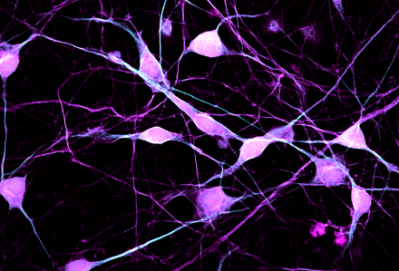 Mature excitatory neurons differentiated from pluripotent stem cells which are induced from Bipolar Disorder patient’s fibroblasts (Magenta: βIII-Tubulin; Cyan: MAP2).