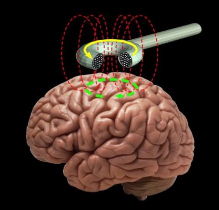 Transcranial Brain Stimulation